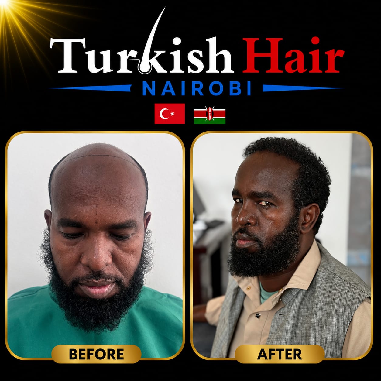 Turkish Hair Nairobi Case 3